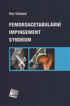 Femoroacetabulární impigement syndrom