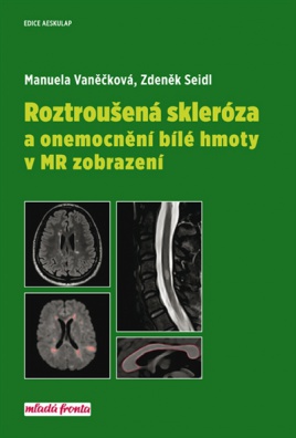 Roztroušená skleróza a onemocní bílé hmoty v MR zobrazení