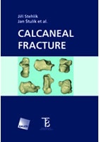 Calcaneal Fracture